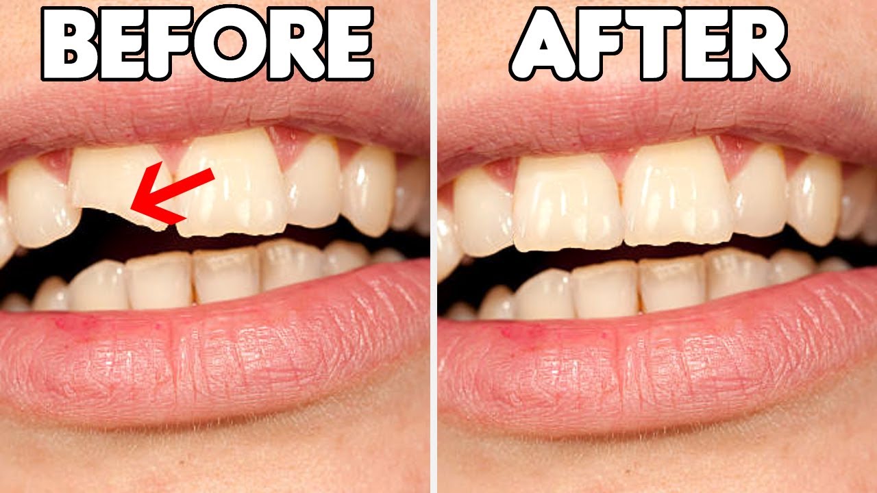 Quanto Costa Riparare Un Dente Scheggiato quanto-costa-riparare-un-dente-scheggiato