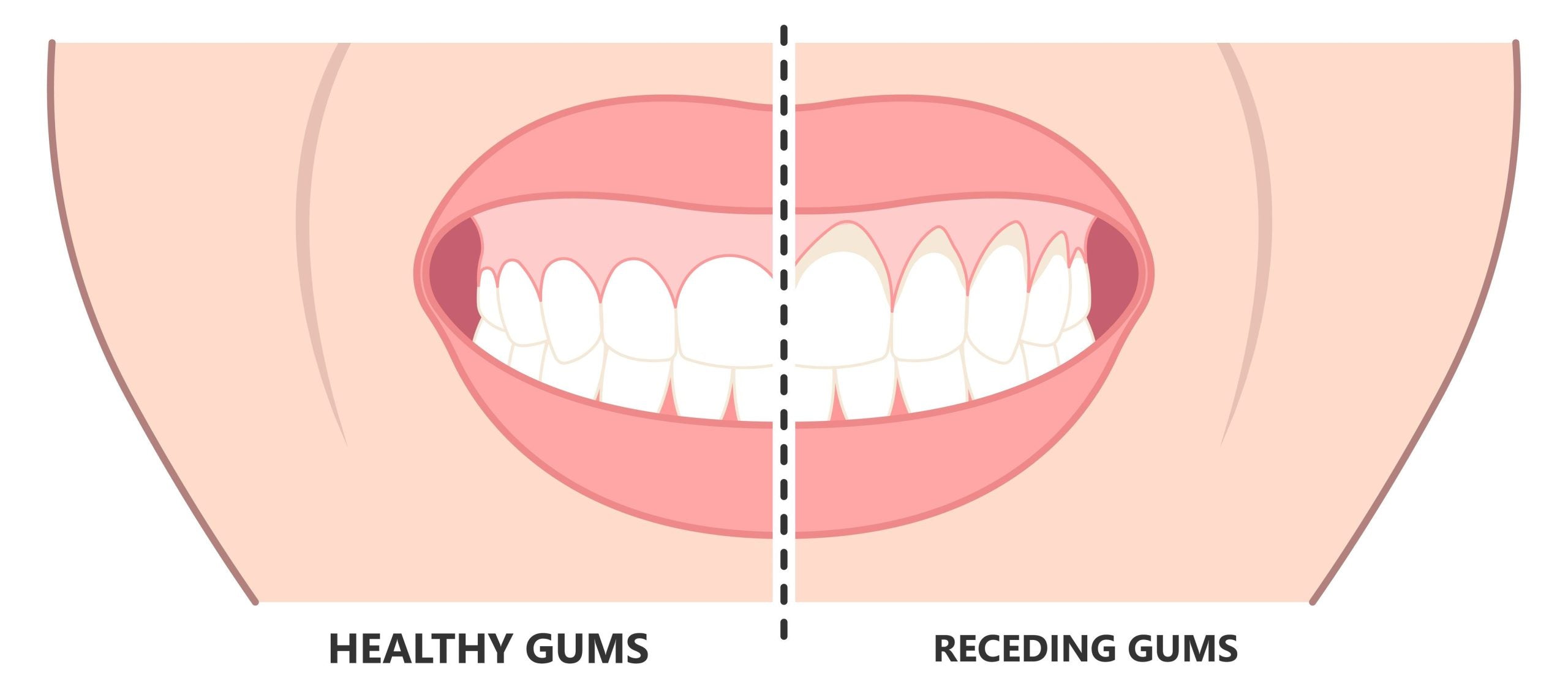 How Far Can Gums Recede Before Teeth Fall Out?