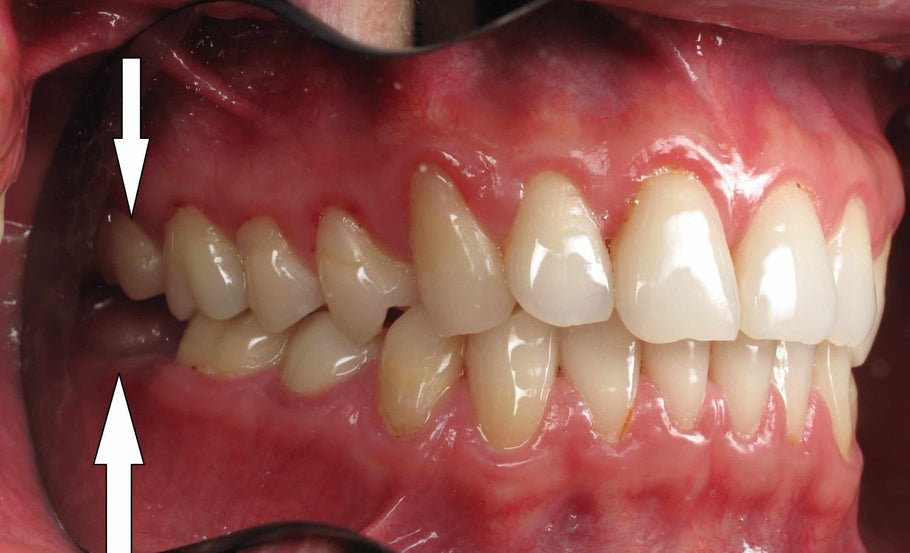 La rimozione dei denti posteriori influisce sulla deglutizione?
