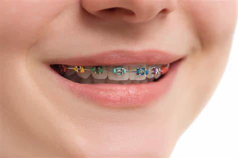 Un dentista può rimuovere la placca con l'apparecchio?