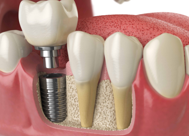 Quanto costano gli impianti dentali?