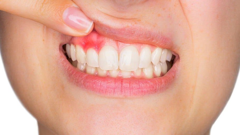 La gengivite è contagiosa? Fatti scientifici sulla trasmissione delle malattie gengivali