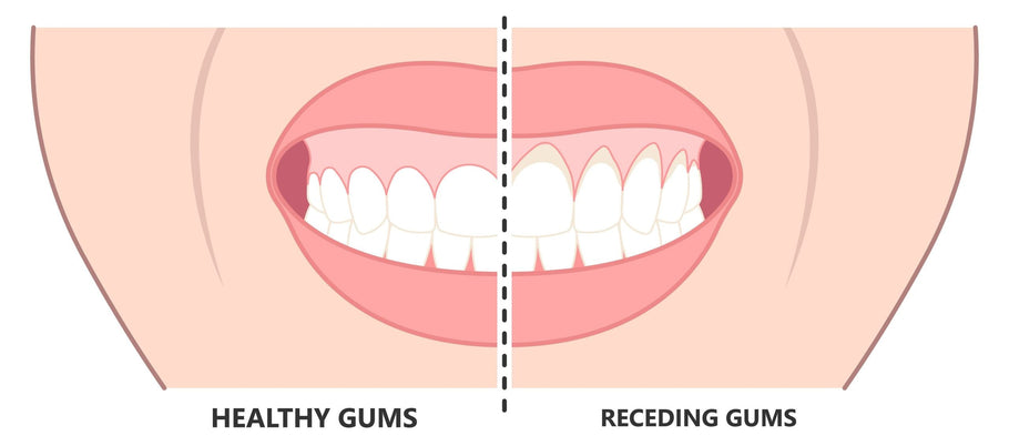 Quanto possono ritirarsi le gengive prima che i denti cadano?