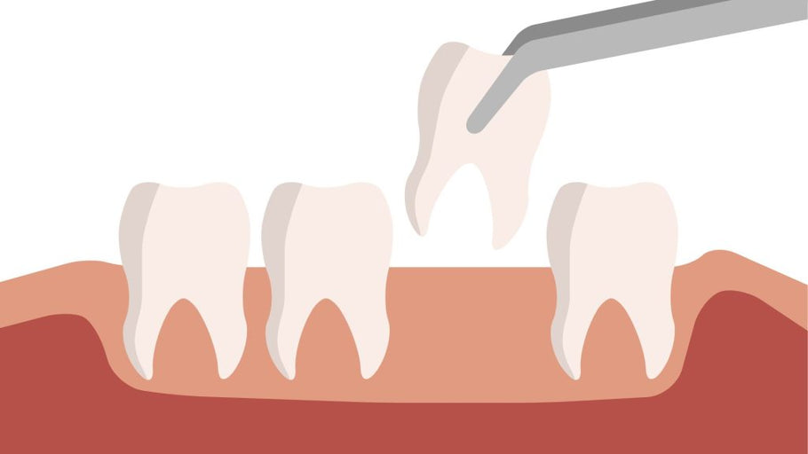 Quanto tempo dopo un'estrazione dentale si può mangiare? Una guida completa