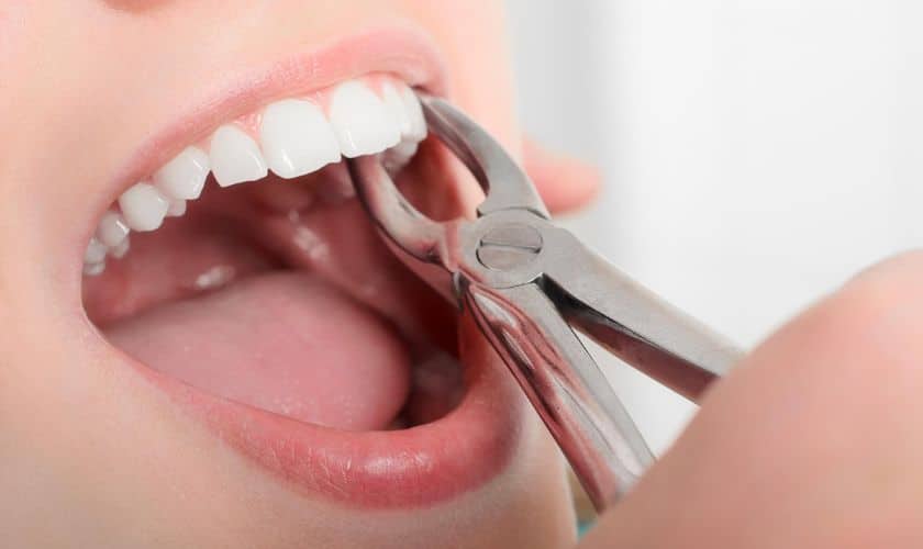 Quanto tempo impiega una estrazione dentale a guarire?