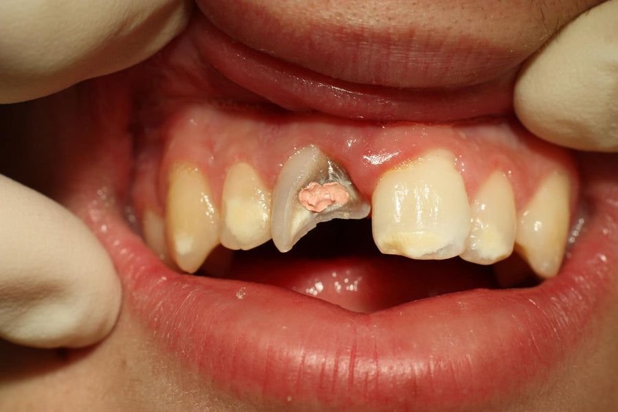 Si può you fare un trattamento canalare con un dente scheggiato?