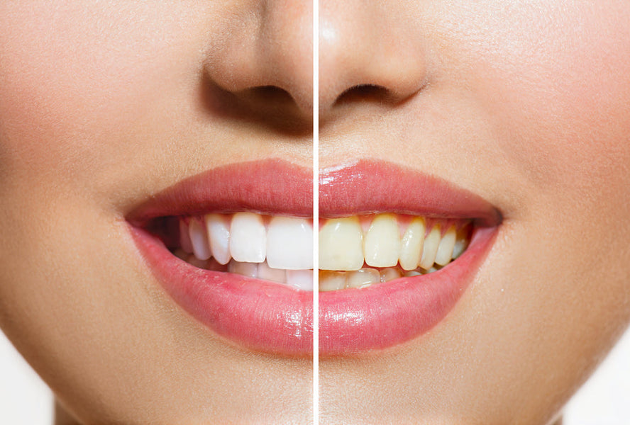 Perché i miei denti sono gialli anche se li lavo ogni giorno?