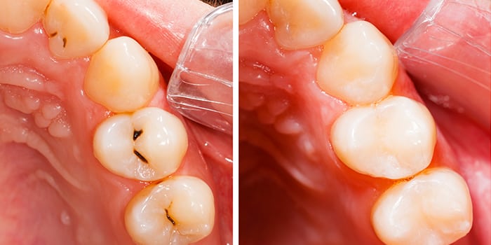 Quanto tempo dopo il riempimento posso lavarmi i denti?