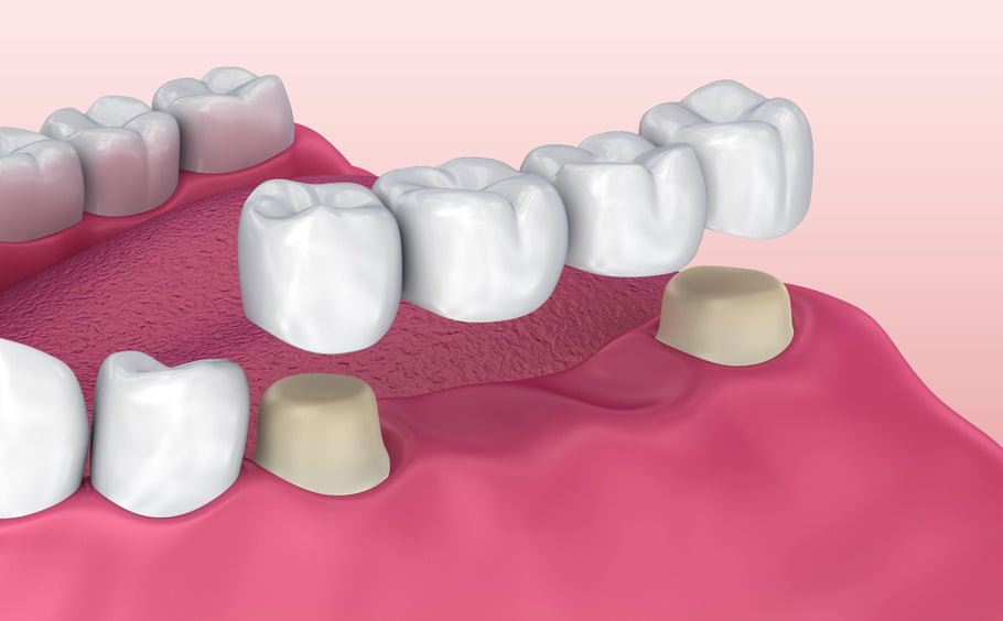 Cos'è un ponte dentale?