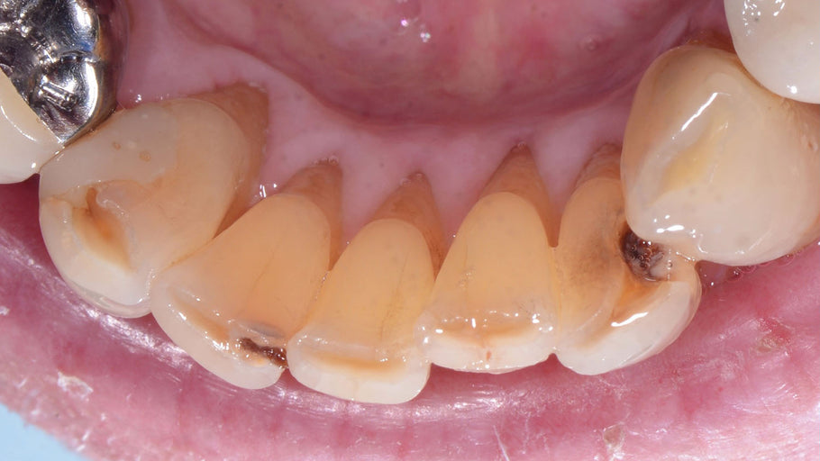 Una radice dentale esposta può causare visione doppia?