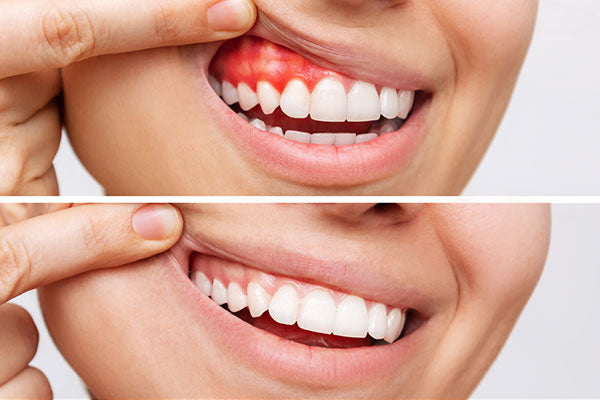 Come curare la malattia gengivale senza dentista: rimedi efficaci a casa e consigli per la prevenzione