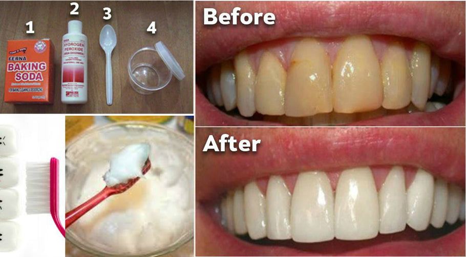 Come rimuovere il tartaro dai denti senza dentista