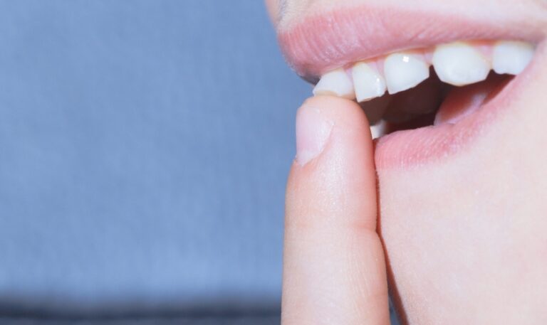 Come stringere un dente allentato a casa?