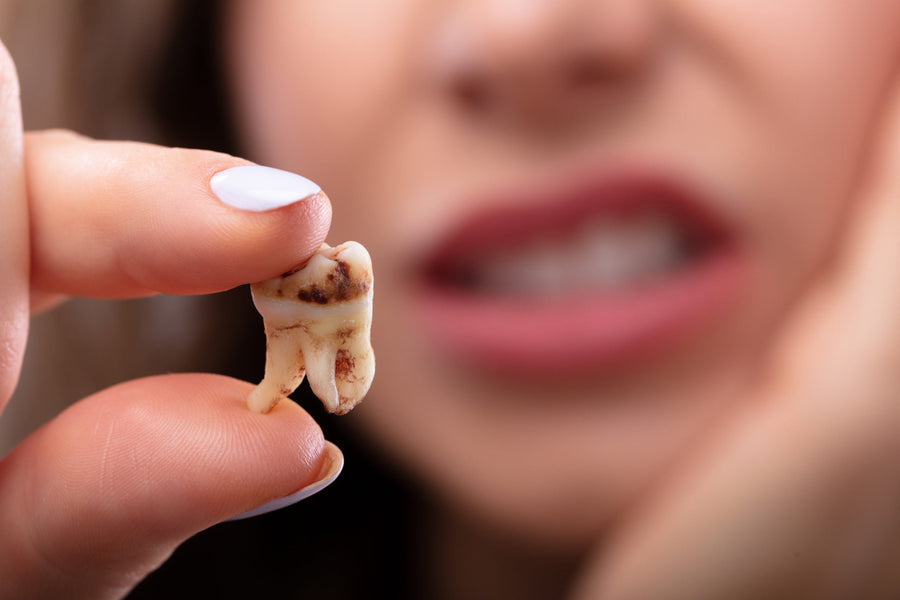 Come rimuovere la carie dentale da soli?