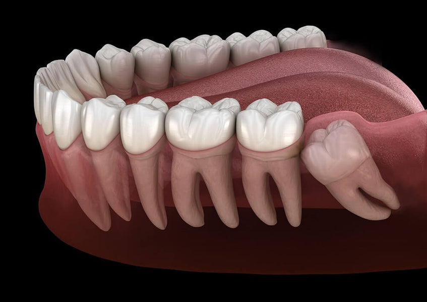 I denti del giudizio possono ricrescere? Miti, fatti e approfondimenti dentistici